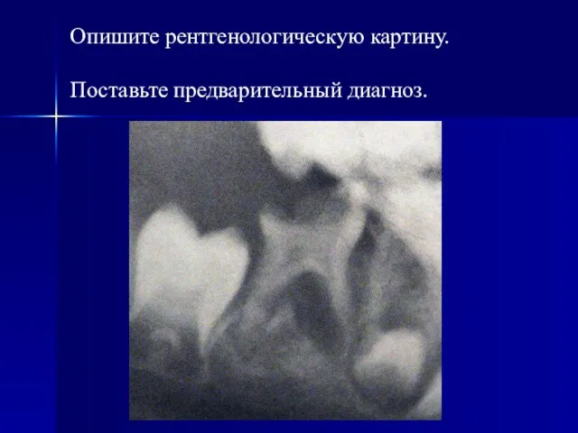 Опишите рентгенологическую картину. Поставьте предварительный диагноз.