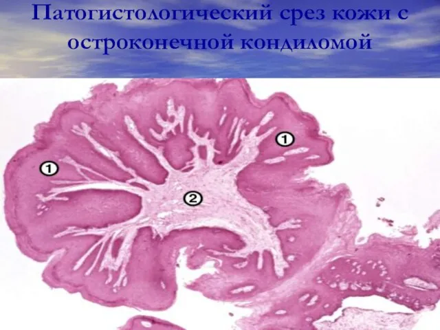 Патогистологический срез кожи с остроконечной кондиломой