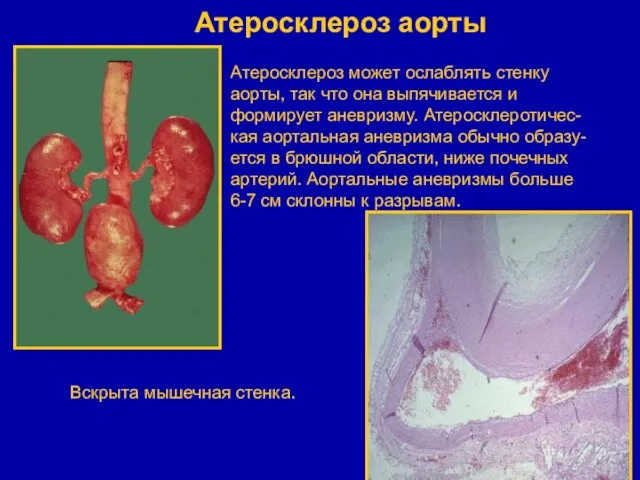 Атеросклероз аорты Вскрыта мышечная стенка. Атеросклероз может ослаблять стенку аорты, так