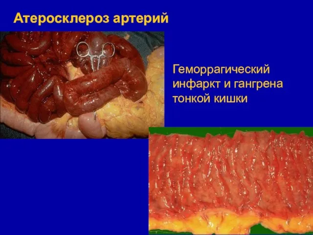 Атеросклероз артерий кишечника Геморрагический инфаркт и гангрена тонкой кишки