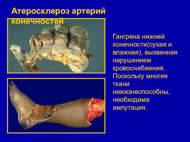 Гангрена нижней конечности(сухая и влажная), вызванная нарушением кровоснабжения. Поскольку многие ткани