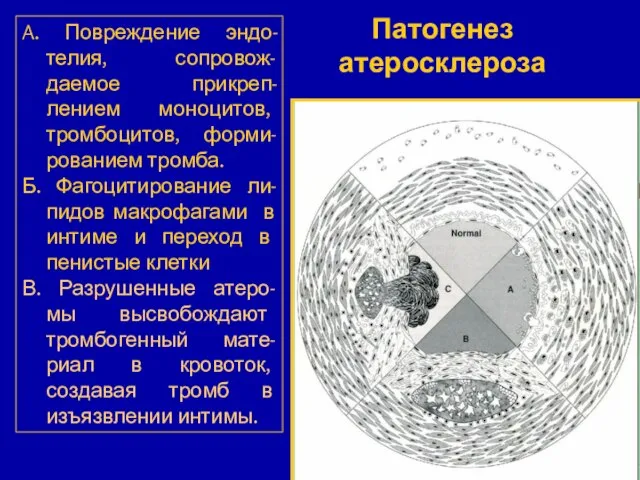 A. Повреждение эндо-телия, сопровож-даемое прикреп-лением моноцитов, тромбоцитов, форми-рованием тромба. Б. Фагоцитирование