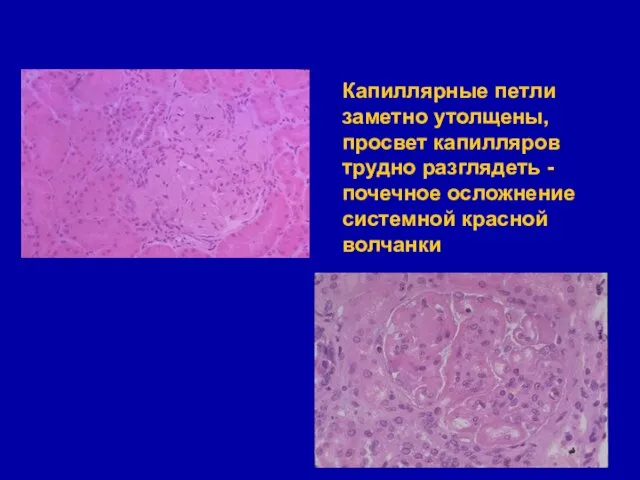 Капиллярные петли заметно утолщены, просвет капилляров трудно разглядеть - почечное осложнение системной красной волчанки