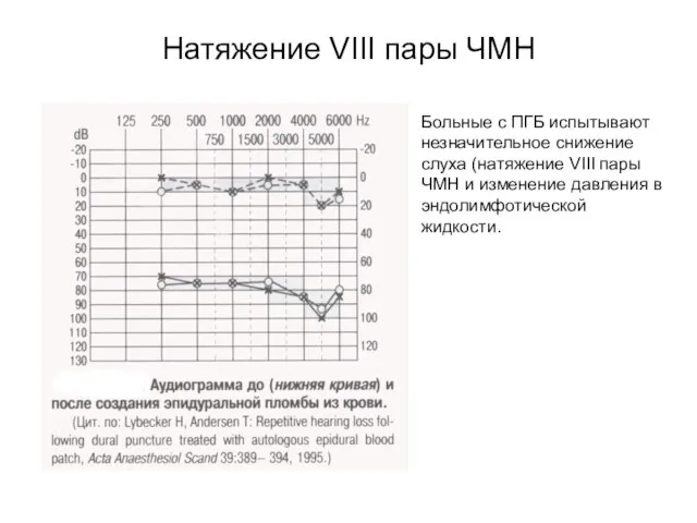 Натяжение VIII пары ЧМН Больные с ПГБ испытывают незначительное снижение слуха