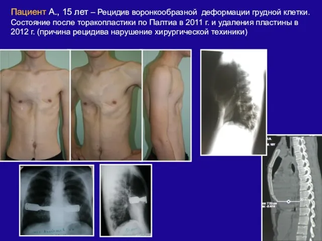 Пациент А., 15 лет – Рецидив воронкообразной деформации грудной клетки. Состояние