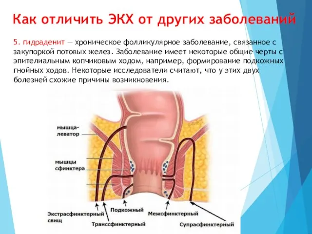 Как отличить ЭКХ от других заболеваний 5. гидраденит — хроническое фолликулярное