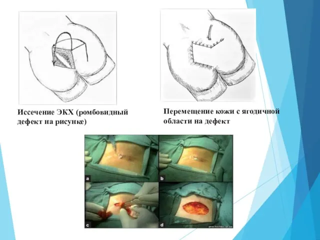 Иссечение ЭКХ (ромбовидный дефект на рисунке) Перемещение кожи с ягодичной области на дефект