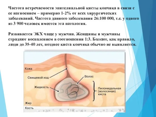 Частота встречаемости эпителиальной кисты копчика в связи с ее нагноением –