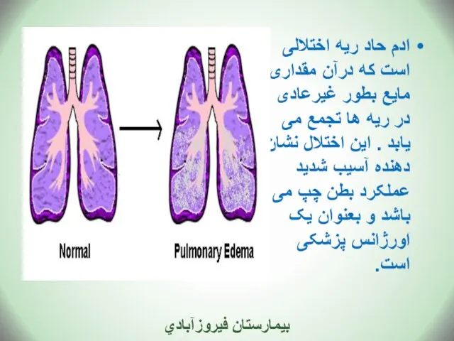 ادم حاد ریه اختلالی است که درآن مقداری مایع بطور غیرعادی