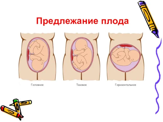 Предлежание плода