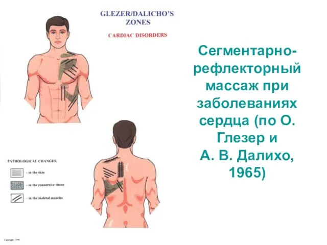 Сегментарно-рефлекторный массаж при заболеваниях сердца (по О. Глезер и А. В. Далихо, 1965)