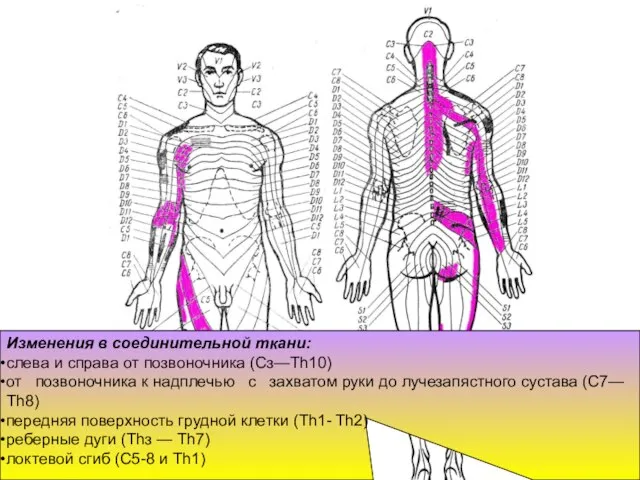 Изменения в соединительной ткани: слева и справа от позвоночника (Сз—Th10) от