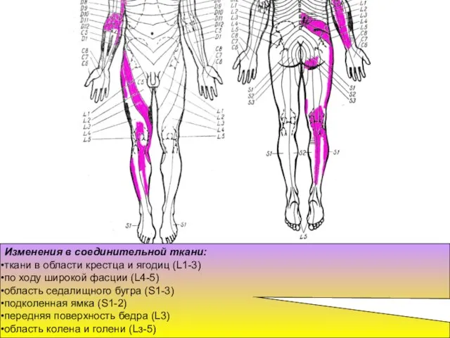 Изменения в соединительной ткани: ткани в области крестца и ягодиц (L1-3)