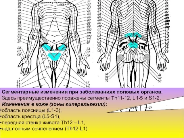 Сегментарные изменения при заболеваниях половых органов. Здесь преимущественно поражены сег­менты Th11-12,