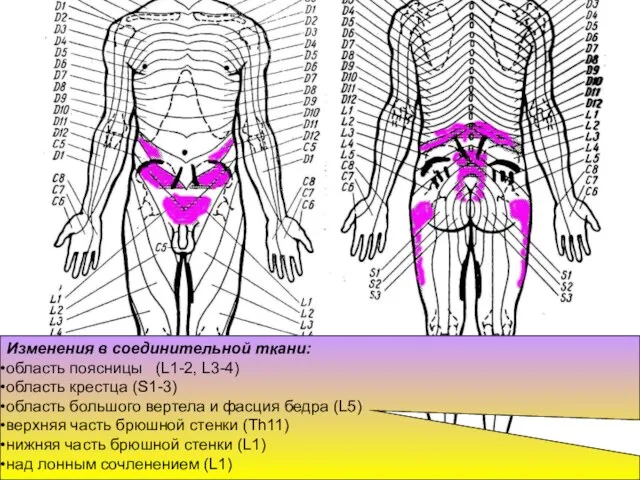 Изменения в соединительной ткани: область поясницы (L1-2, L3-4) область крестца (S1-3)