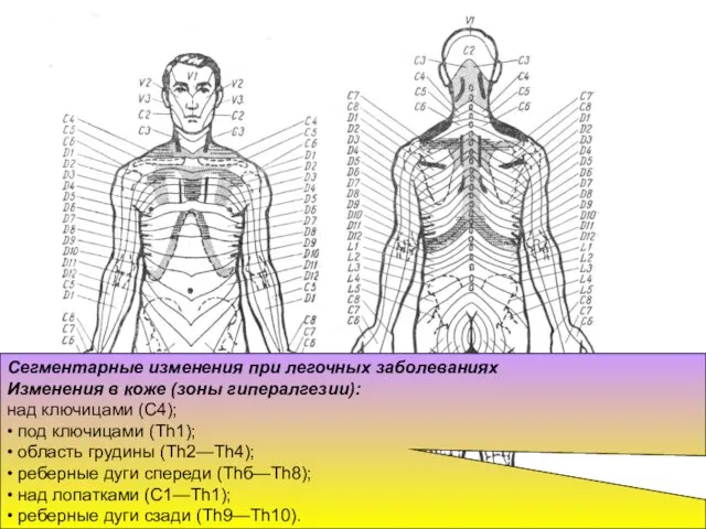 Сегментарные изменения при легочных заболеваниях Изменения в коже (зоны гипералгезии): над