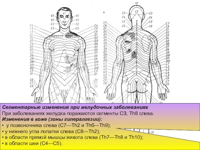 Сегментарные изменения при желудочных заболеваниях При заболеваниях желудка поражаются сегменты СЗ,