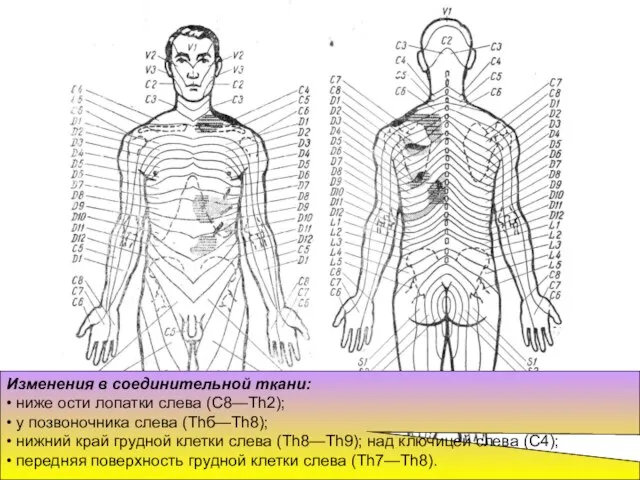 Изменения в соединительной ткани: • ниже ости лопатки слева (С8—Th2); •