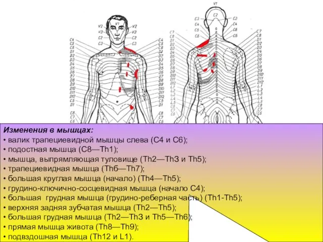 Изменения в мышцах: • валик трапециевидной мышцы слева (С4 и С6);
