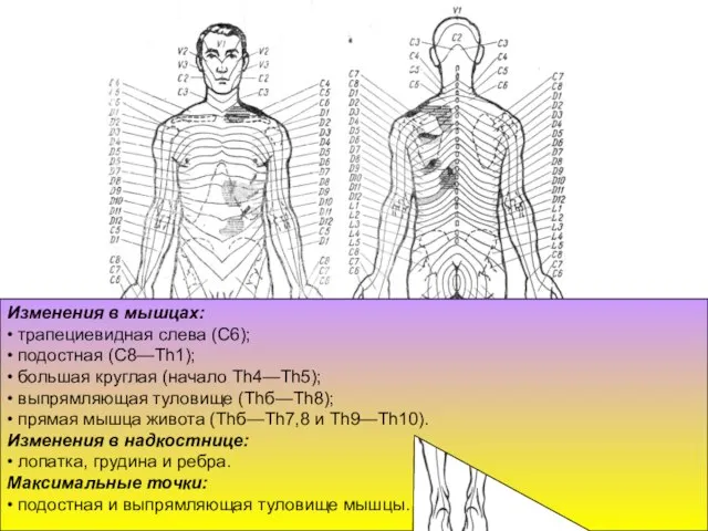 Изменения в мышцах: • трапециевидная слева (С6); • подостная (С8—Th1); •