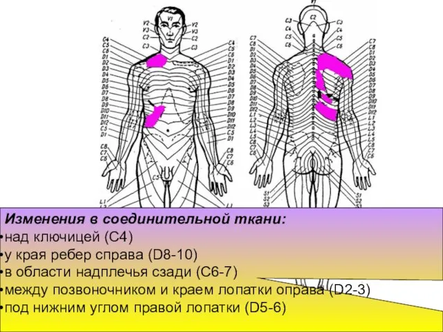 Изменения в соединительной ткани: над ключицей (С4) у края ребер справа