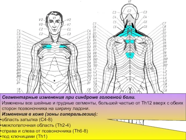 Сегментарные изменения при синдроме головной боли. Изменены все шейные и грудные