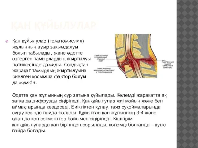 ҚАН ҚҰЙЫЛУЛАР Қан құйылулар (гематомиелия) – жұлынның ауыр зақымдалуы болып табылады,