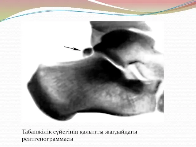 Табанжілік сүйегінің қалыпты жағдайдағы рентгенограммасы