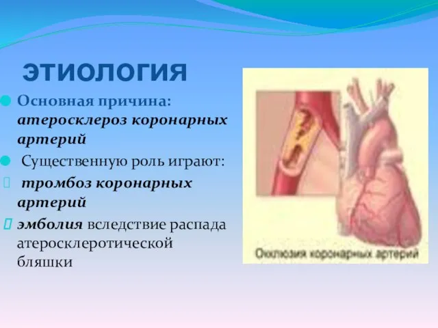 этиология Основная причина: атеросклероз коронарных артерий Существенную роль играют: тромбоз коронарных