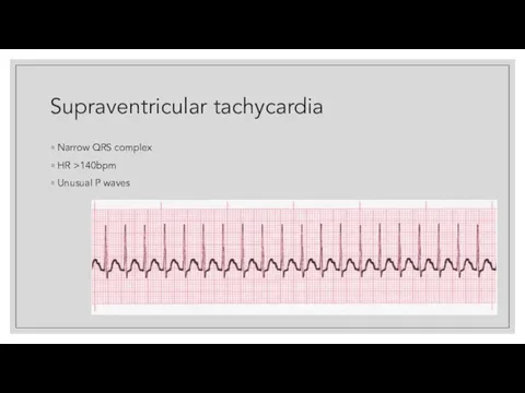 Supraventricular tachycardia Narrow QRS complex HR >140bpm Unusual P waves