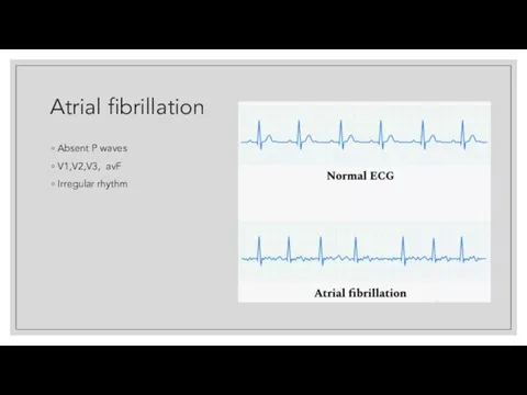 Atrial fibrillation Absent P waves V1,V2,V3, avF Irregular rhythm