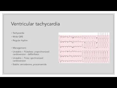 Ventricular tachycardia Tachycardia Wide QRS Regular rhythm Management: Unstable + Pulseless: