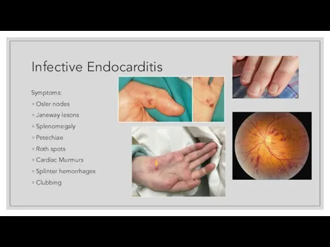 Infective Endocarditis Symptoms: Osler nodes Janeway lesons Splenomegaly Petechiae Roth spots Cardiac Murmurs Splinter hemorrhages Clubbing