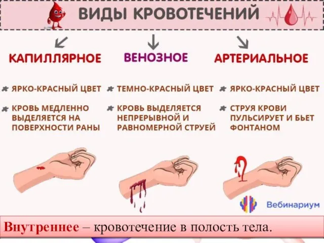 Внутреннее – кровотечение в полость тела.