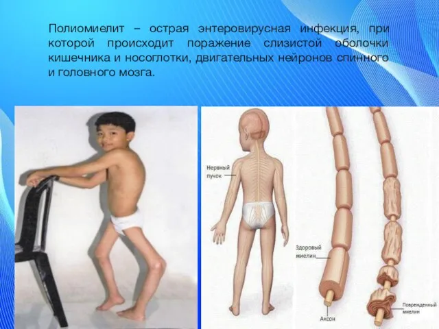 Полиомиелит – острая энтеровирусная инфекция, при которой происходит поражение слизистой оболочки