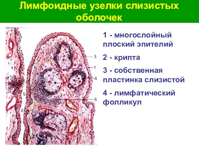 Лимфоидные узелки слизистых оболочек 1 - многослойный плоский эпителий 2 -
