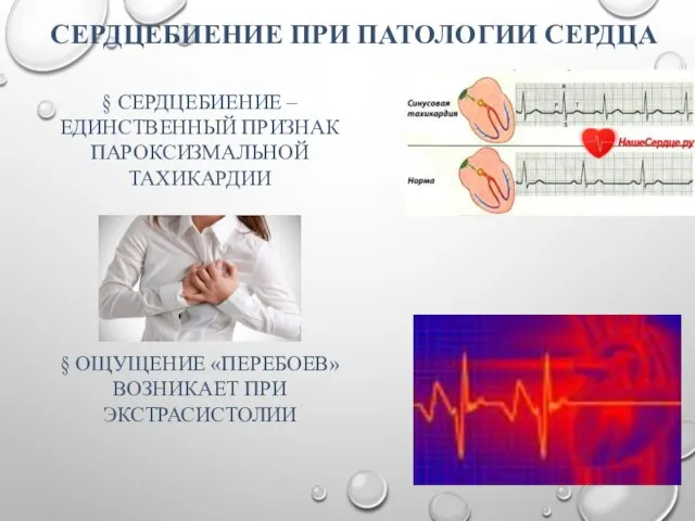 § СЕРДЦЕБИЕНИЕ – ЕДИНСТВЕННЫЙ ПРИЗНАК ПАРОКСИЗМАЛЬНОЙ ТАХИКАРДИИ § ОЩУЩЕНИЕ «ПЕРЕБОЕВ» ВОЗНИКАЕТ