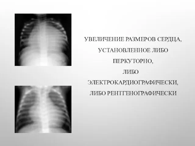 УВЕЛИЧЕНИЕ РАЗМЕРОВ СЕРДЦА, УСТАНОВЛЕННОЕ ЛИБО ПЕРКУТОРНО, ЛИБО ЭЛЕКТРОКАРДИОГРАФИЧЕСКИ, ЛИБО РЕНТГЕНОГРАФИЧЕСКИ