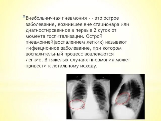 Внебольничная пневмония - - это острое заболевание, возникшее вне стационара или