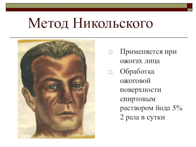 Метод Никольского Применяется при ожогах лица Обработка ожоговой поверхности спиртовым раствором