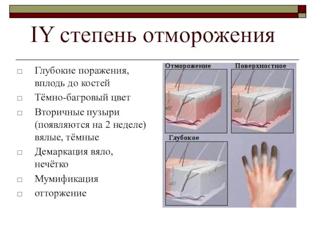 IY степень отморожения Глубокие поражения, вплодь до костей Тёмно-багровый цвет Вторичные