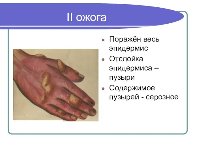 II ожога Поражён весь эпидермис Отслойка эпидермиса – пузыри Содержимое пузырей - серозное