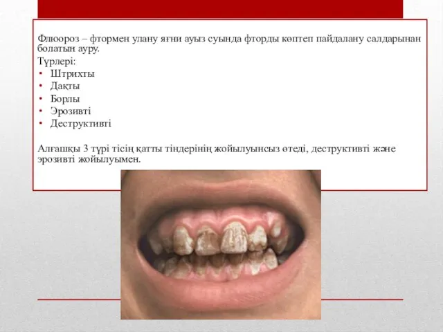 Флюороз – фтормен улану яғни ауыз суында фторды көптеп пайдалану салдарынан