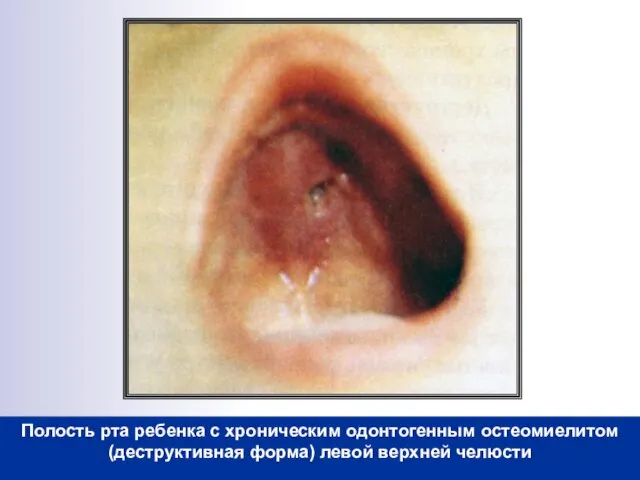Полость рта ребенка с хроническим одонтогенным остеомиелитом (деструктивная форма) левой верхней челюсти
