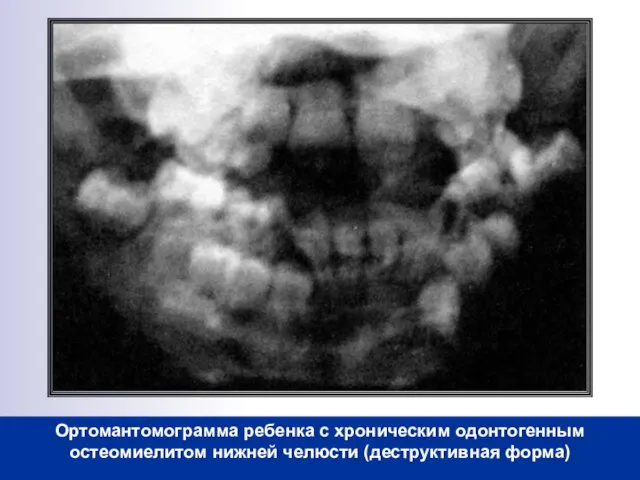 Ортомантомограмма ребенка с хроническим одонтогенным остеомиелитом нижней челюсти (деструктивная форма)