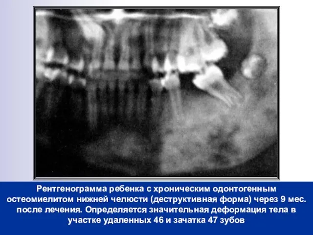 Рентгенограмма ребенка с хроническим одонтогенным остеомиелитом нижней челюсти (деструктивная форма) через