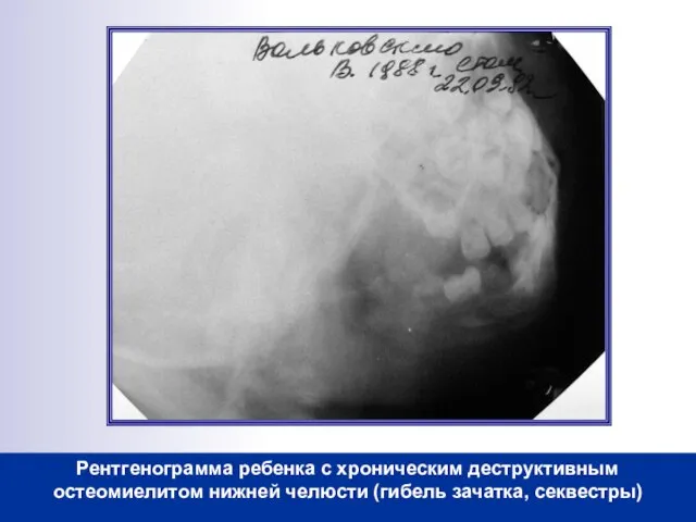 Рентгенограмма ребенка с хроническим деструктивным остеомиелитом нижней челюсти (гибель зачатка, секвестры)