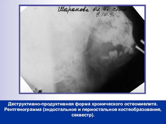 Деструктивно-продуктивная форма хронического остеомиелита. Рентгенограмма (эндостальное и периостальное костеобразование, секвестр).