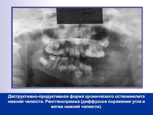 Деструктивно-продуктивная форма хронического остеомиелита нижней челюсти. Рентгенограмма (диффузное поражение угла и ветви нижней челюсти).
