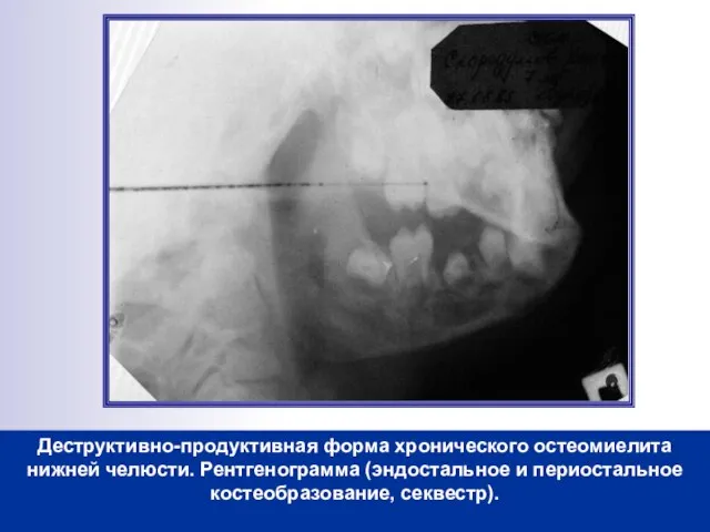 Деструктивно-продуктивная форма хронического остеомиелита нижней челюсти. Рентгенограмма (эндостальное и периостальное костеобразование, секвестр).